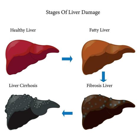 Stages of liver damage. Healthy, fatty, liver fibrosis and cirrhosis. isolated on white background. eps 10 Liver Segments, Liver Fibrosis, Liver Damage, Kidney Detox, Live Picture, Healthy Liver, Medical Illustration, Cityscape Photos, Nature Backgrounds