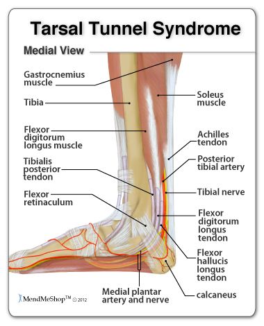 Tarsal Tunnel Syndrome (TTS) causes pain in the foot, ankle, and toes. Tarsal Tunnel, Ankle Anatomy, Gastrocnemius Muscle, Calf Cramps, Ankle Pain, Pain Relief Cream, Leg Pain, Body Anatomy, Hip Pain