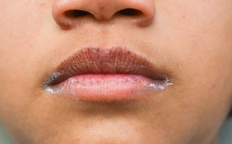 Cracked Lip Corners? You May Be Dealing With Angular Cheilitis | HUM Nutrition Blog Cracked Lip Corners, Angular Cheilitis, Hangover Headache, Sore Lips, Sunburn Peeling, Hum Nutrition, Dry Cracked Lips, Natural Face Care, B12 Deficiency