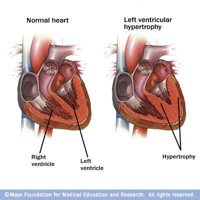 Cardiac Ischemia, Left Ventricular Hypertrophy, Interventional Radiology, Normal Heart, Young Blood, Nursing Tips, Body Tissues, Health Conditions, Natural Treatments