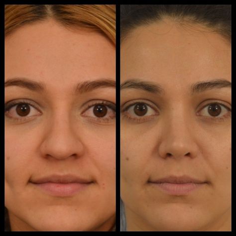 Wide Nose Surgery, Nose Job Before And After Bulbous, Perfect Nose Front View, Wide Nose Rhinoplasty, Closed Rhinoplasty, Jaw Reduction Surgery, Nose Plastic Surgery, Nose Surgery Rhinoplasty, Ethnic Rhinoplasty