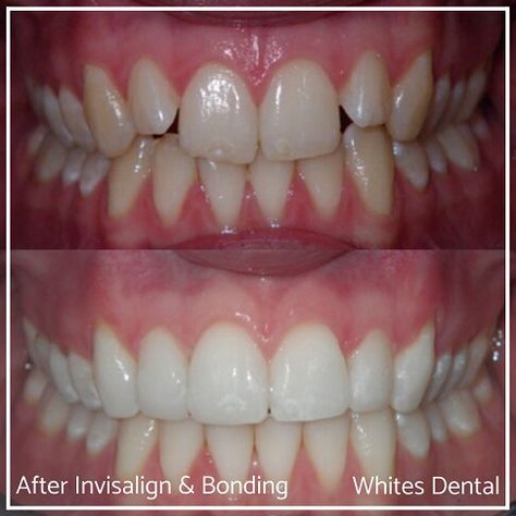 Teeth Bonding Before And After, Composite Bonding Before And After, Dental Bonding Before And After, Composite Veneers Before And After, Composite Bonding Teeth Before And After, Composite Bonding Teeth, Teeth Composite, Teeth Makeover, Teeth Bonding