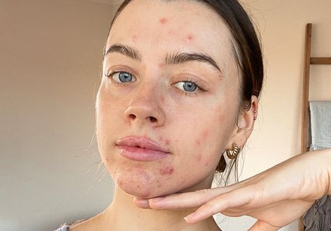 Pimple Under The Skin, Girl With Acne, Lemon Face Mask, Face Mapping Acne, Blind Pimple, Pimples Under The Skin, Acne Makeup, Natural Acne Remedies, Under The Skin