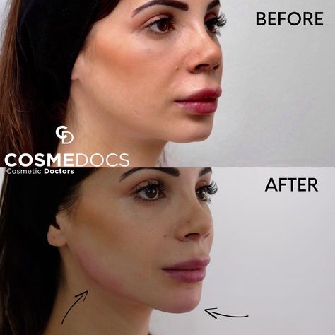 Chin & Jawline 📐 Even slim faces can lack definition and this is where jawline contouring is especially effective. Once again, we always look at the chin...as you can’t have a good jawline without a strong defined chin to complete the profile. PS Top lip here is swollen post rhinoplasty weeks before, not from lip filler 💉 Hyaluronic Acid filler to enhance jawline and chin structure 🤕 Minimal - Topical numbing cream and anaesthetic in filler ⏰ Takes approx 30-40 mins and lasts 1.5-2 years 🇬🇧 Jawline Contouring, Sagging Jowls, Good Jawline, Cheek Implants, Chin Filler, Chin Implant, Cheek Lift, V Shape Face, Under Eye Fillers