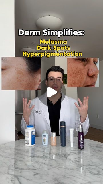 Dr Charles, MD | Health & Beauty Expert✨ on Instagram: "Derm Simplifies: Melasma/Hyperpigmentation - @drcharlesmd breaks down common otc effective options for hyperpigmentation! ❤️ Find this helpful? Hit that share button to help others learn. Up next, simplifying: ✅ beauty supplements ✅ drying your hair ✅ mental health check in ✅ weight loss hacks Follow @drcharlesmd for more beauty and health ✨simplified✨ What else should we learn about? . . . #simple #easy #dermatology #doctor #healthy #lifestyle #melasma #pregnancy #beauty #cosmetics #lifehacks #cosmetics #acne #darkspots" Tomato Skin Care, Dermatology Doctor, Skin Care Hyperpigmentation, Skin Care Home Remedies, Facial Routines, Dry Skin Body, Share Button, Brown Spots On Face, Dermatological Skin Care