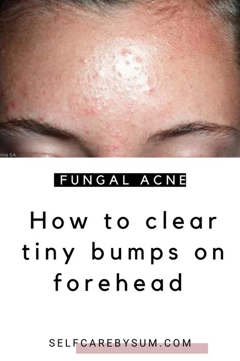 Generated Description with relevant hashtags. Tiny Bumps On Forehead, Forehead Pimples, Nails Remedies, Forehead Breakout, Nizoral Shampoo, Small Bumps On Face, Forehead Bumps, Head Acne, Spots On Forehead