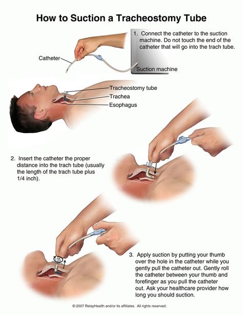 Gather equipment and provide privacy for patient.  Perform hand hygiene.  Assist the patient to a semi-Fowler’s or Fowler’s position i... Nurse Skills, Med Surg Nursing, Nursing Assessment, Nurse Study Notes, Nursing Mnemonics, Nursing Student Tips, Nursing School Survival, Learn Hindi, Nursing School Studying