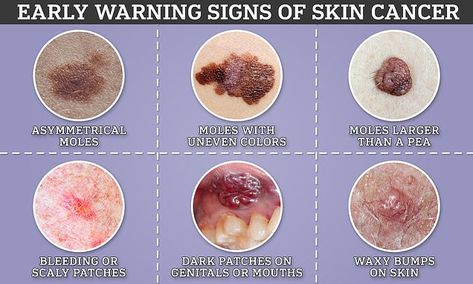 Cancerous Moles, Basal Cell, Skin Grafting, Squamous Cell, Scaly Skin, 80 Percent, Skin Disorders, Types Of Cancers, Flaky Skin