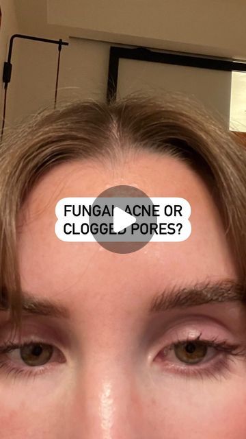 Natalie O’Neill on Instagram: "How to banish the bumps ❌ 

1. There are usually two things the bumps can be: clogged pores or fungal acne, or a mix of both (always fun).

2. It’s more likely to be fungal acne if they suddenly appeared out of nowhere, are itchy or have spread quickly. It’s more likely to be clogged pores if you’ve gotten them gradually over time and acne products do work on them.

3. Fungal acne triggers are: heat, humidity, sweat. For example, wearing a hat on holiday can cause it, though it’s not always caused this way. Clogged pores are caused by: not cleansing properly or using products your skin disagrees with (or both!).

4. The best remedy for fungal acne is an anti fungal treatment like Nizoral shampoo, or terbinafine hydrochloride. It should clear up within a week Fungal Acne Remedies, Really Bad Acne, Acne Triggers, Nizoral Shampoo, Forehead Acne, Fungal Acne, Acne Products, Out Of Nowhere, Acne Remedies