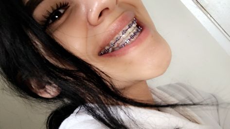 Braces Dark Purple, Purple Power Chain Braces, Dark Purple Braces Teeth, Braces Colors Purple, Dark Purple Braces, Light Purple Braces, Lavender Braces, Orange Braces, Purple Braces