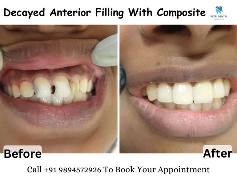 Say goodbye to decayed anterior fillings and hello to a radiant smile! 🌟 Check out these stunning before-and-after pics showcasing our expertise in restoring smiles with composite fillings. Witness the transformative power of precision and care at Vetri Dental Clinic Tirunelveli. Ready to revitalize your smile? Call 9894572926 or visit https://vetridentalclinictirunelveli.com/ to schedule an appointment today. Let us bring your smile back to life! 💙😁 #DentalTransformation #CompositeFillings Composite Fillings, Dental Fillings, Before And After Pictures, Back To Life, Your Smile, Dental Clinic, Dental Care, Bring It On, Let It Be