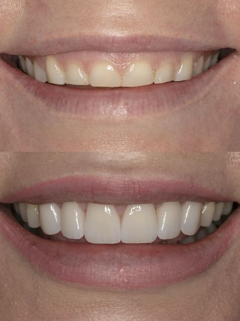 gum lift before and after Gum Lift, Gummy Smile Correction, Gummy Smile, Many People, Fix It, Gum, Quick Saves