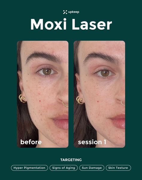 Moxi ensures a glowing complexion year-round, making it your go-to solution for radiant, flawless skin 🌟 Book on-demand, vetted medical aesthetic treatments👩🏻‍⚕️ near you📍on the Upkeep app✨ Available on iOS & Google Play!📲💉 #BookedOnUpkeep⁠ Moxi Laser Before And After, September Photoshoot, Aesthetic Treatments, Lip Augmentation, Botox Fillers, Sun Damaged Skin, The Glow Up, Nose Job, Medical Aesthetic