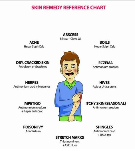 Homeopathy Skin remedy chart for acne, abscess, boils, eczema, hives, itchy skin, stretch marks, herpes, cracked skin. Get effective remedies for skin diseases online Impetigo Remedies, Remedies For Skin, Homeopathy Remedies, Homeopathy Medicine, Acne Oil, Homeopathic Medicine, Cracked Skin, Skin Remedies, Homeopathic Remedies