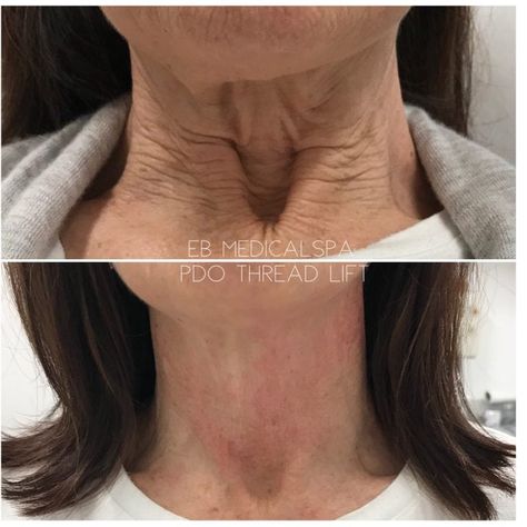 Pdo Thread Lift Neck, Threading Face Lift, Pro Thread Lift Before And After, Pdo Thread Lift Before And After Neck, Pdo Threads Under Eyes, Thread Face Lift Before And After, Thread Lift Before And After, Pdo Threads Before And After, Thread Lift Face Before And After