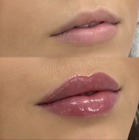 Lip Fillers Juvederm, Lip Flip, Lips Inspiration, Face Fillers, Permanente Make-up, Botox Lips, Drag Make-up, Facial Fillers, Facial Aesthetics