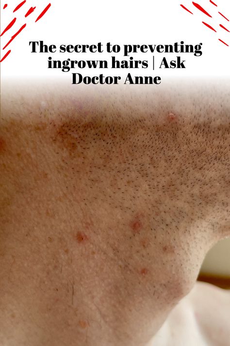 Are you fed up with ingrown hairs and want to learn how to prevent and treat them? Then look no further than this video! Here you will get all the up-to-date advice on how to prevent and treat ingrown hairs. Doctor Anne will provide her top tips on ingrown hair prevention, as well as give her professional opinion and insight on the best treatments available. No more searching endlessly for a solution - Doctor Anne will provide the answers. Treat Ingrown Hair, Inflamed Skin, Natural Face Cleanser, Homemade Facial Mask, Lower Back Pain Exercises, Natural Hair Mask, Prevent Ingrown Hairs, Best Barber, Ingrown Hairs