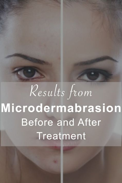 Dermabrasion Before And After, Microdermabrasion Benefits, Botox Results, Home Microdermabrasion, Botox Before And After, Microdermabrasion Machine, Salon Ideas, Anti Aging Beauty, Anti Wrinkle Cream