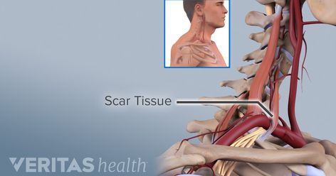 How the Graston Technique Works Graston Technique, Soft Tissue Injury, Neck Injury, Spine Health, Dr Berg, Shoulder Injuries, Dr J, Pelvic Pain, Scar Tissue