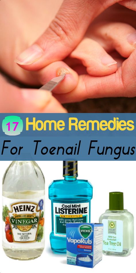 17 Home Remedies for Toenail Fungus Toenail Fungus Remedies, Tongue Health, Toenail Fungus, Nail Fungus, Natural Health Remedies, Natural Home Remedies, Health And Beauty Tips, Tea Tree Oil, Health Remedies