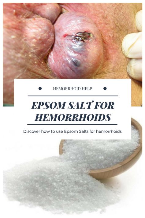 back pain relief Hemorrhoid Removal, Thrombosed Hemorrhoid, Hemorrhoid Remedies, Hemorrhoid Relief, Holistic Remedies, Natural Detox, Epsom Salt, Health Check, Health Facts