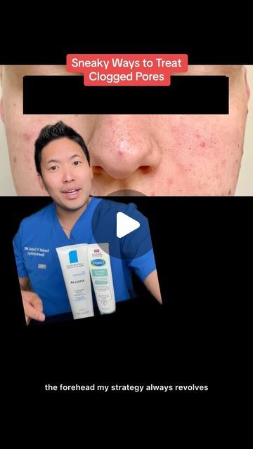 Dr. Daniel Sugai, MD, FAAD on Instagram: "Yes, the stitched video has a combination of comedones and sebaceous filaments which are a bit different but the management can be quite similar. Here are Sneaky ways to treat clogged pores! 1️⃣use a cleanser with either salicylic acid or benzoyl peroxide (okay to have both products but don’t double up on them in a single day- would alternate every other day): Cetaphil Gentle Clear Benzoyl Peroxide cleanser or La Roche-Posay Effaclar Sal acid cleanser  2️⃣use a retinoid: otc adapalene 0.1% gel comes in La Roche-Posay Effaclar or Differin gel 3️⃣chemical peels can be quite useful as the above pointers may not always do the job especially over the nose! I can say that my patients love getting peels during the fall through spring months. If you rather Clogged Pores On Nose, Cetaphil Gentle Clear, Benzoyl Peroxide Cleanser, Sebaceous Filaments, Differin Gel, La Roche Posay Effaclar, Chemical Peels, Spring Months, Benzoyl Peroxide