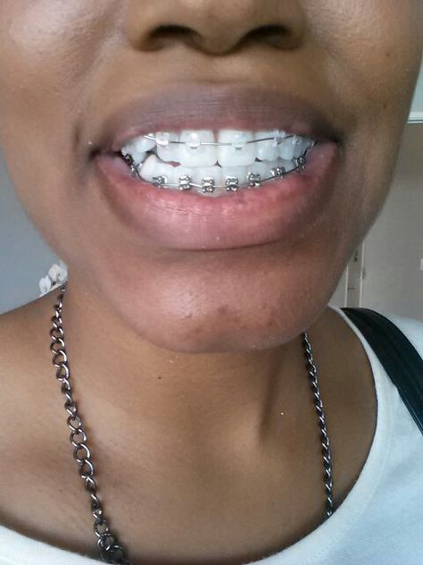 Two year plan clear on top and metal on the bottom Bottom Braces, Braces Clear, Lingual Braces, Clear Braces, Metal Braces, Clear Top, Year Plan, Braces, Health