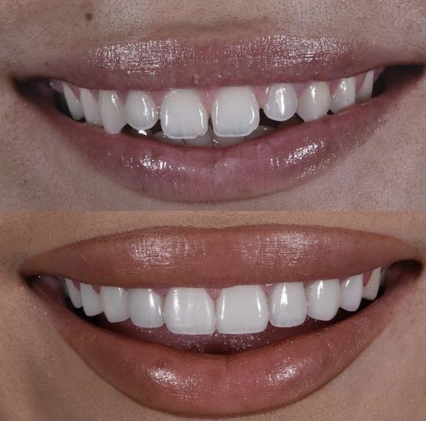 Teeth Correction, Perfect Skin Routine, Teeth Aesthetic, Fix Teeth, Cosmetic Dentistry Procedures, Composite Veneers, Veneers Teeth, Strong Teeth, Aesthetic Dentistry