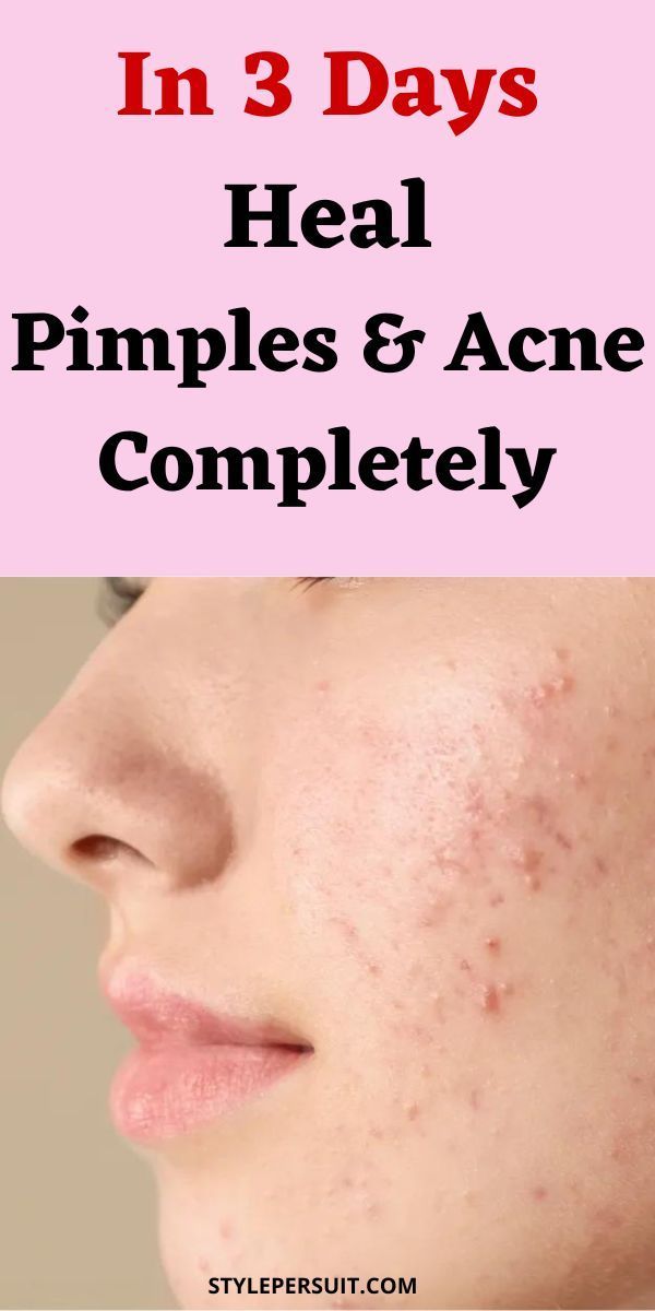 Do you really want to know how to get rid of pimples overnight fast? You have probably tried several pimple treatments and recommendations from friends without much success. You can now relax because we are going to give you effective pimple remedies that will help you say goodbye to pimples once and for all. Whether you have pimples on face, pimples on scalp, chin, on buttocks, or under the skin, you will be able to remove them easily. Click to get these effective pimple remedies overnight. How To Rid Of Acne, How To Get Rid Of Bad Acne Fast, Body Pimples Remedies, How To Get Rid Of Pimples On Your Vag, Homemade Pimple Remedies Overnight, Pimples On Face Removal, How To Get Rid Of Pimples Fast, Pimples On Face Meaning, How To Get Rid Of Pimples Overnight