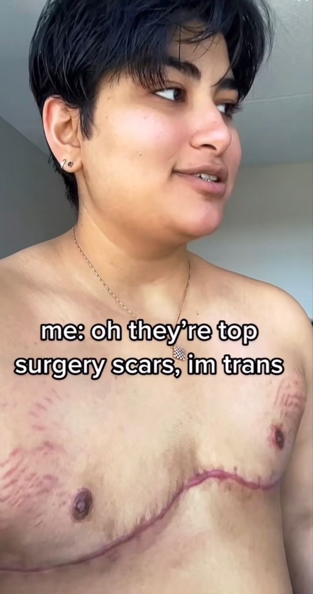 Top Surgery Scar Designs, Transmasc Top Surgery, Plus Size Top Surgery, Trans Men Top Surgery, Trans Top Surgery, Trans Top Surgery Tattoos, Top Surgery Art, Trans Man Art, Top Surgery Ftm