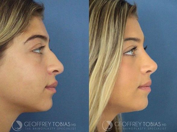 Jaw Reduction Surgery, Face Plastic Surgery, Nose Surgery Rhinoplasty, Nose Fillers, Plastic Surgery Fail, Rhinoplasty Nose Jobs, Face Fillers, Rhinoplasty Before And After, Plastic Surgery Gone Wrong