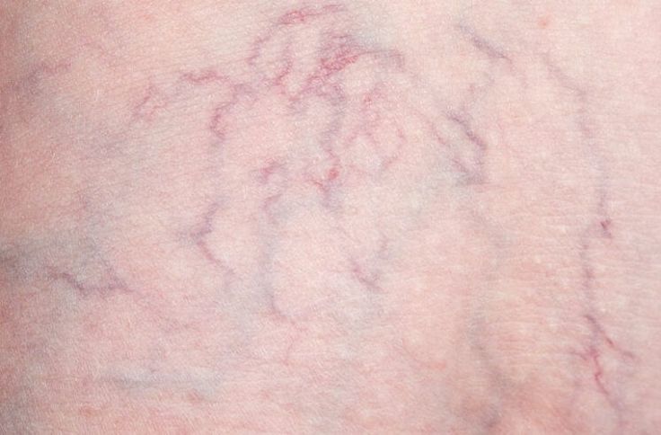 How Varicose and Spider Veins Are Different – Cleveland Clinic Vericous Veins, Facial Veins, Varicose Veins Causes, Leg Ulcers, Visible Veins, Venous Insufficiency, Medical School Motivation, Cleveland Clinic, Laser Therapy