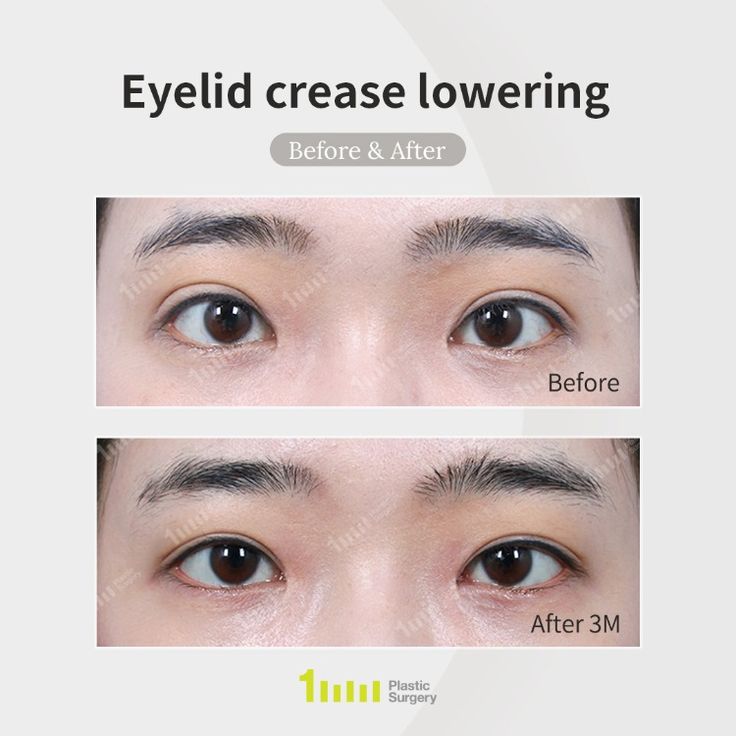 👉🏻 ”Sausage” eyelids They are permanently swollen puffy eyelids due to the double eyelid fold being too high for the eye. 👨🏻‍⚕️🔍 The main point of high double eyelid fold correction is to completely release the previous adhesions. 1mm of delicate release of adhesions creates a natural and beautiful double eyelid line. 🏅 Over 6000+ positive reviews 🏅 High Level of Customer Satisfaction | ⭐️9.1 📲 +𝟖𝟐𝟏𝟎-𝟒𝟑𝟗𝟏-𝟏𝟏𝟕𝟏 (𝐖𝐡𝐚𝐭𝐬𝐚𝐩𝐩) 📩 𝐄𝐧𝐠@𝟏𝐦𝐦𝐩𝐬.𝐜𝐨𝐦 💚 en.1mmps.com/ Double Eyelids Korean, Korean Plastic Surgery, Double Eyelid, Upper Eyelid, Korean Cosmetics, Cosmetic Surgery, Plastic Surgery, Surgery, Nose Ring