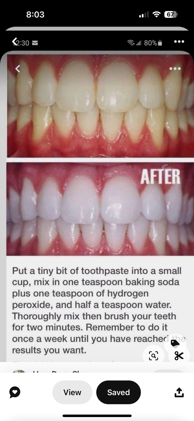 Natural Teeth Whitening Diy, Diy Coconut Oil, Teeth Whitening Remedies, Teeth Whitening Diy, Charcoal Teeth Whitening, Baking Soda Shampoo, Natural Teeth Whitening, Natural Teeth, Oral Health Care