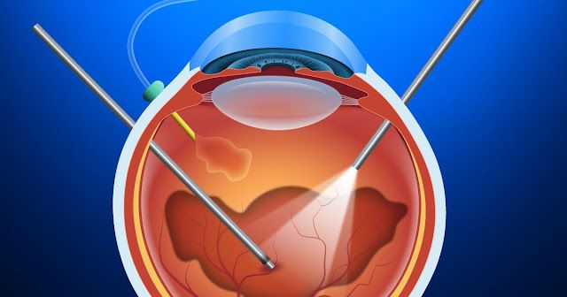 Dive into the world of Vitreoretinal Surgery! @ https://windycityretina.blogspot.com/2023/09/shedding-light-on-vitreoretinal-surgery.html Eye Surgeon, General Anaesthesia, Eye Hospital, Laser Surgery, Eye Infections, Last Resort, Vision Problems, Eye Surgery, Scar Tissue