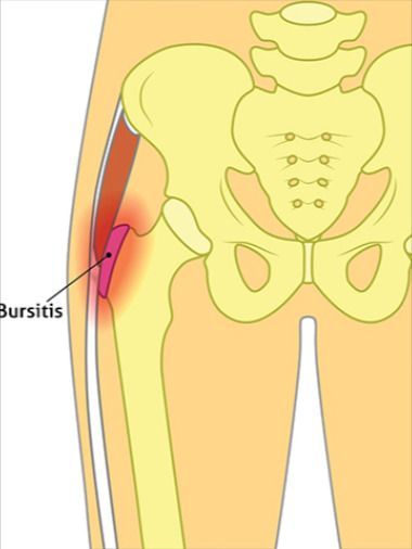 Hip Bursa Symptoms, What Is Bursitis Hip Pain, Outer Hip Pain, Bursitis Hip Relief, Hip Pain Causes, Hip Pain Relief Remedies, Hip Flexor Exercises, Bursitis Hip, Chronic Pain Awareness