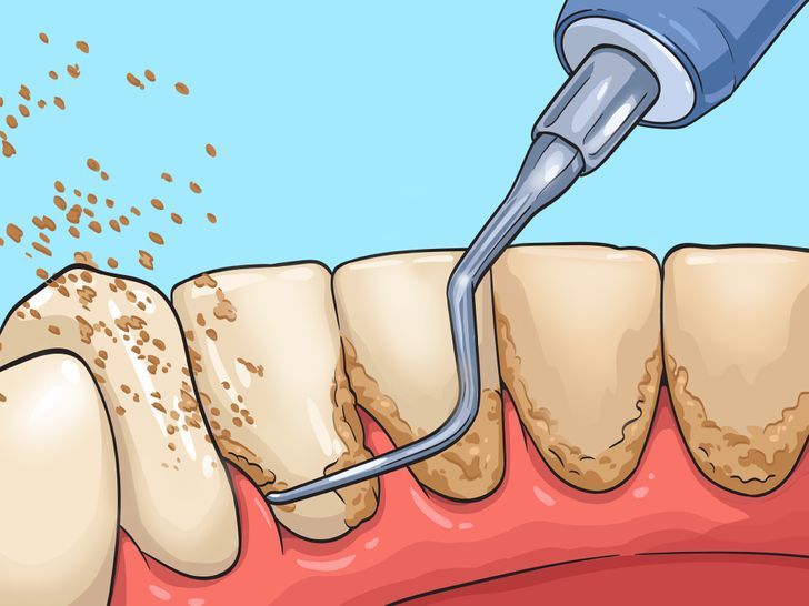 How To Get Rid Of Plaque Build Up, How To Remove Hardened Plaque, How To Get Plaque Off Teeth, Diy Plaque Remover Teeth, How To Remove Plaque From Teeth, How To Clean Plaque From Teeth, Clean Teeth Plaque How To Remove, Teeth Plaque Removal At Home, Get Rid Of Plaque On Teeth