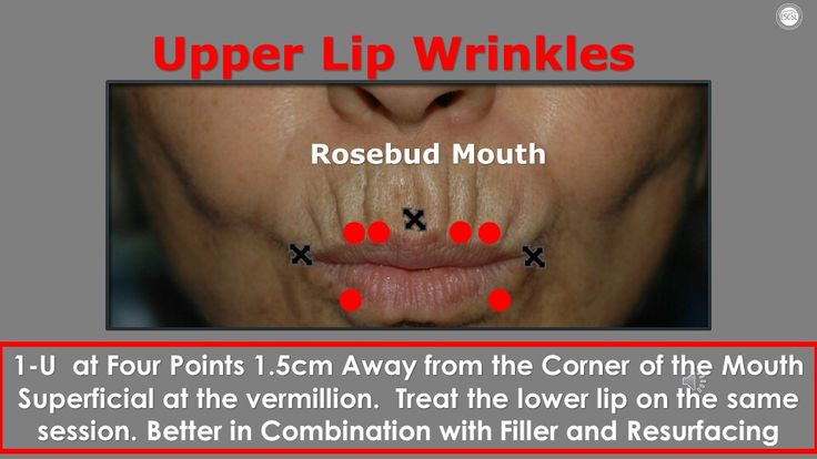 Upper Lip Wrinkles, Botox Face, Face Mapping, Mole Removal, Lip Wrinkles, Botox Fillers, Aesthetic Medicine, Botox Injections, Lower Lip