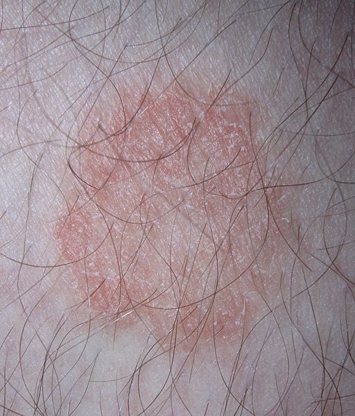 A Home Remedy for Ringworm That Works Common Skin Rashes, Fungal Rash, Fungal Infection Skin, Antifungal Cream, Home Remedies For Skin, Skin Disorders, Fungal Infection, Skin Remedies, Natural Home Remedies