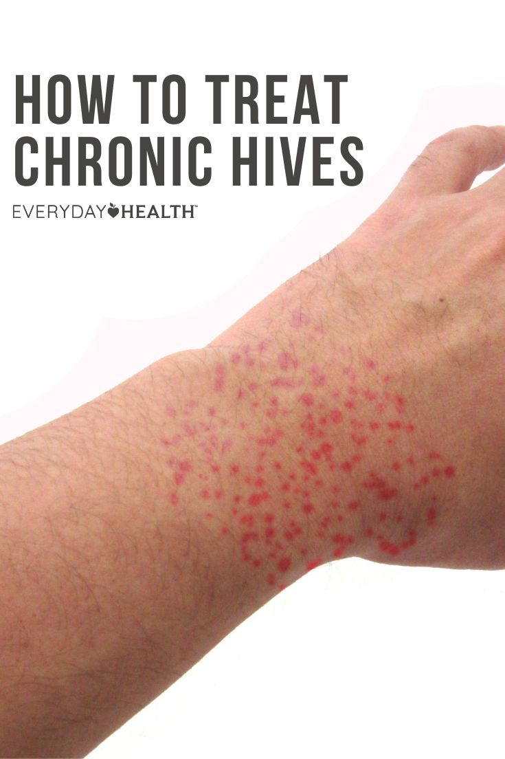 When it comes to treating hives, there are many home remedies that can help. Doctors say DO moisturize your skin, but skip the over-the-counter anti-itch creams (which can actually make the hives worse). Get Rid Of Hives Fast, How To Treat Hives, Remedies For Hives, Allergy Hives, Home Remedies For Hives, Types Of Skin Rashes, Itching Remedies, Hives Remedies, Chronic Hives