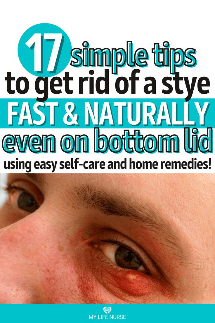 person's eye with stye on bottom lid Sty Remedy How To Get Rid, Sty In The Eye Remedies How To Get Rid, Get Rid Of A Stye Overnight, Stye Remedies Fast Essential Oils, Remedies For Stye On Eyelid, How To Get Rid Of Stye Eye, Stye Remedies Fast How To Get Rid At Home, Sty Eye Remedies How To Get Rid, Natural Remedies For Stye Eye