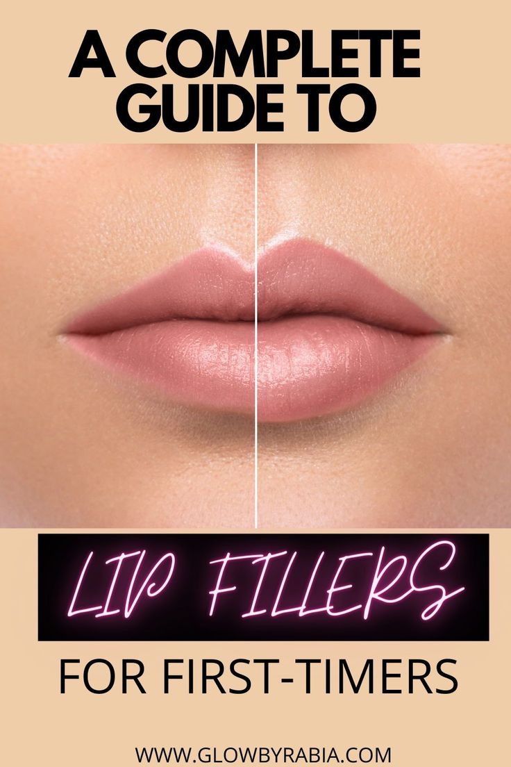 Best Lip Filler, Lip Filler Injection Points, Mini Lip Filler Before And After, Best Lip Fillers Before And After, Getting Lip Fillers, Lip Enhancement Before And After, Minimal Lip Fillers, Lip Injections Shapes Before And After, 1ml Lip Filler Shapes