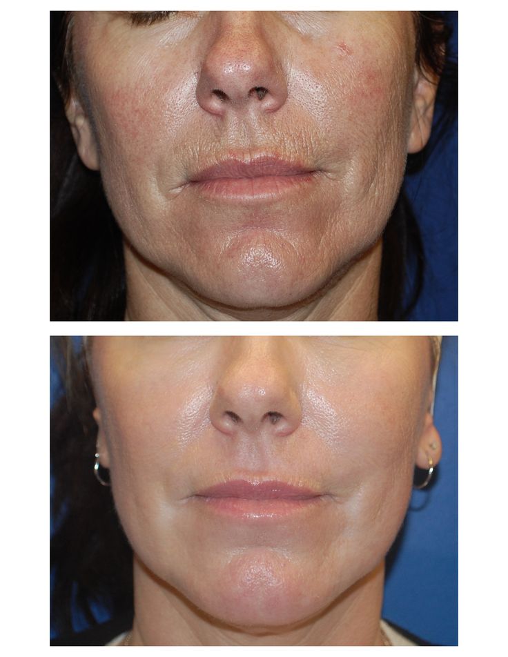 Erbium laser resurfacing. Call us 480-946-7100 or infiniskin.com Erbium Laser, Laser Resurfacing, Skin Resurfacing, Cosmetic Procedures, Deep Wrinkles, New Technology, Wrinkles, Healing, Skin