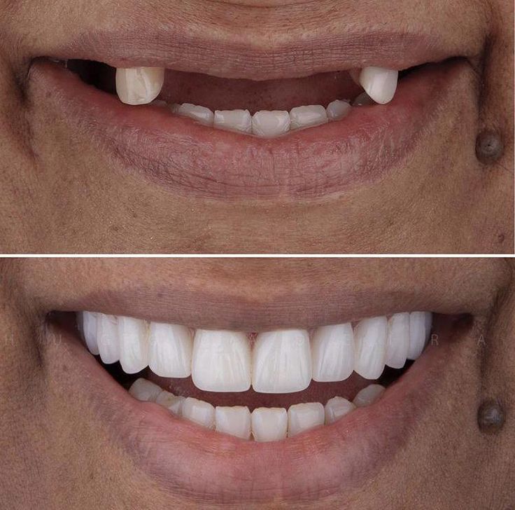 Permanent Dentures, Dental Content, Dental Post, Clinic Art, Snap On Smile, Hollywood Smile, Dental Logo Design, Dental Posts, Tooth Whitening