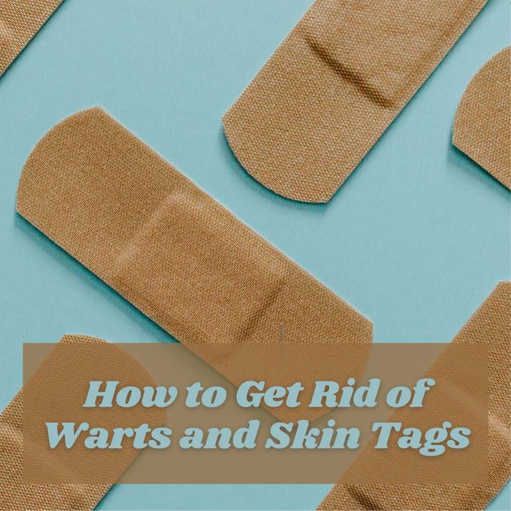 Removing Warts On Face, Wart Remover Diy, How To Get Rid Of Warts On Face, Get Rid Of Skin Tags Fast, Remove Skin Tags Naturally Apple Cider, Skin Tags How To Get Rid Of Diy, Skin Tags Removal Overnight How To Get Rid, Natural Ways To Remove Skin Tags, How To Get Rid Of Skin Tags Fast