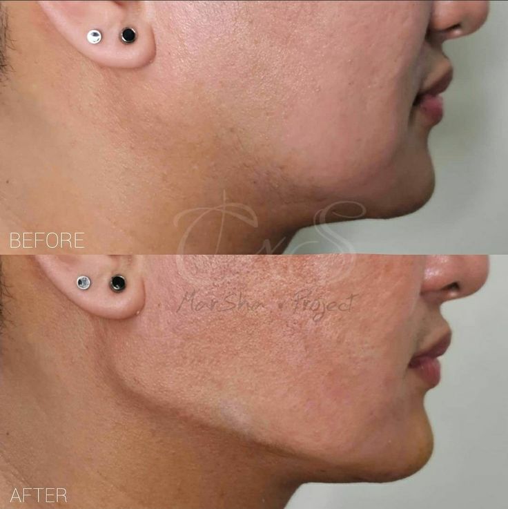 💉Jaw filler procedure is also referred to as nonsurgical jawline contouring. It’s a minimally invasive cosmetic procedure that should only be done by an experienced, licensed professional cosmetic/aesthetic doctor. 💉Jaw fillers are gels that get injected into the skin. They provide volume and stimulate hyaluronic acid or collagen production. This can lessen the appearance of sagging, baggy skin, and bone loss around the jaw. Jaw Filler, Jawline Contouring, Cosmetic Aesthetic, Aesthetic Doctor, Dark Triad, Facial Contouring, Bone Loss, Cosmetic Procedures, Collagen Production