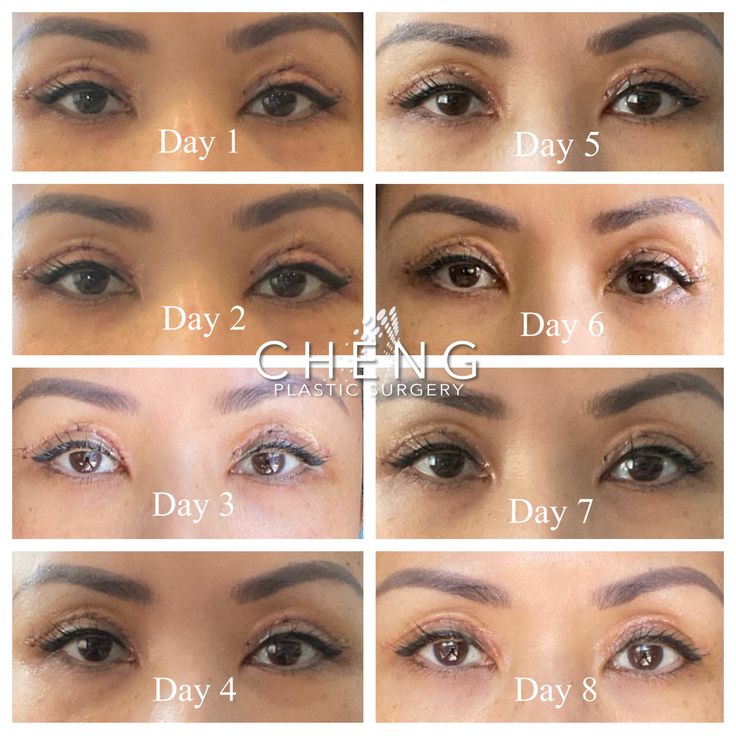 #asianeyelids #eye #eyelids #surgery #cosmetics #aesthetic #before #after #beforeandafter #beauty Eye Lid Surgery Before And After, Asian Double Eyelid, Douyin Makeup Double Eyelid, Monolid Vs Double Eyelid, Korean Eye Surgery, Upper Eyelid Lift Surgery, Double Eyelid Surgeries, Cosmetics Aesthetic, Lasik Eye Surgery