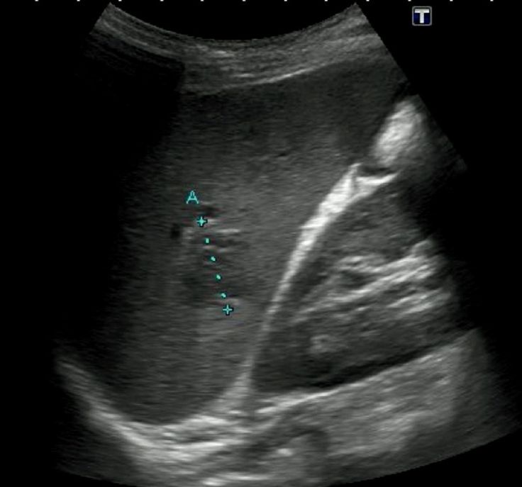 Abdominal Ultrasound, Medical Sonography, Anatomy Images, Diagnostic Medical Sonography, Inflammation Causes, Gi Tract, Lymph Nodes, Stomach Pain, Internal Medicine