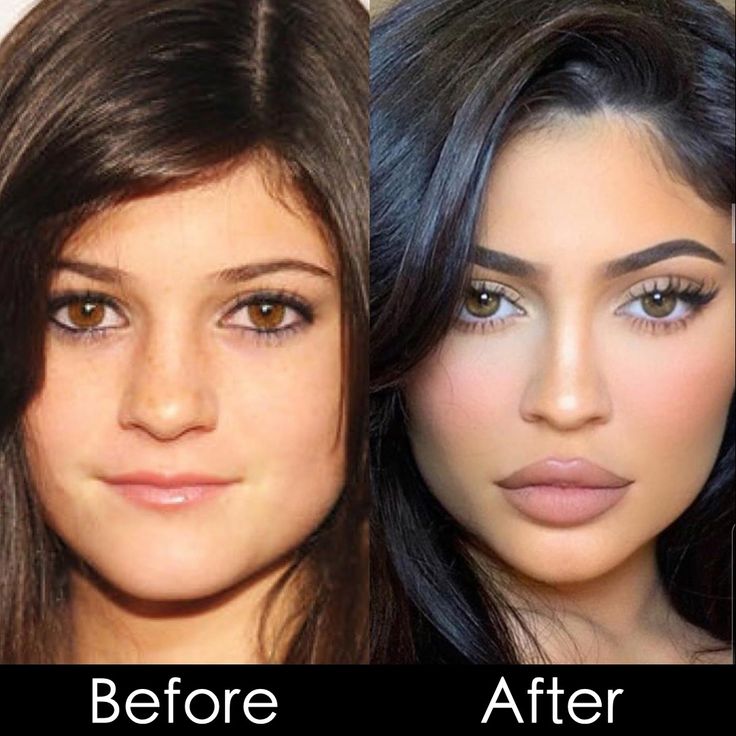 Buccal Fat Removal, the procedure that permanently removes the chubby cheeks to achieve a celebrity or model chiseled look #buccalfatremvoal #buccalfatpadtemoval #drmesa #drjohnmesa Fat Noses Models, Chubby Cheeks Aesthetic, Fat Nose, Lip Fillers Juvederm, Kylie Jenner Plastic Surgery, Buccal Fat Removal, Cheek Implants, Plastic Surgery Fail, Botox Before And After