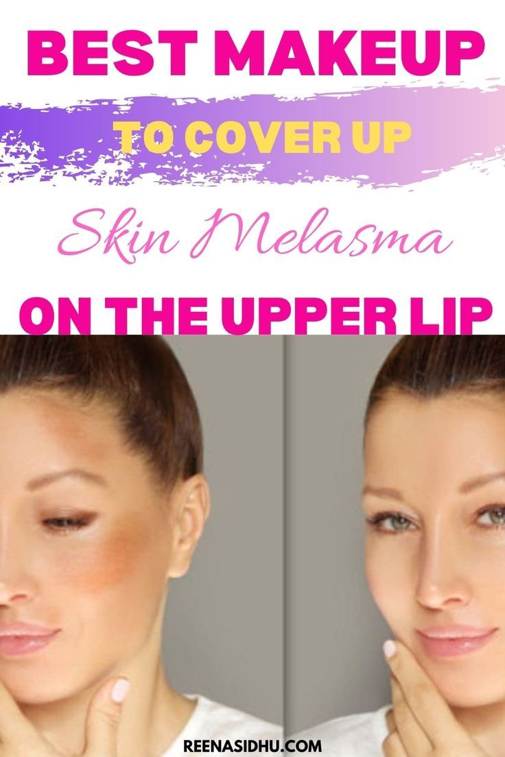 You’ve just finished applying foundation, concealer, and powder to your whole face, only to discover that your hyperpigmentation is still visible. What’s going on? Suppose you have Melasma (a form of hyperpigmentation marked by brown spots on the cheeks, forehead, and upper lip). In that case, you know how tough it is to conceal the condition. When it comes to the best makeup to cover Melasma on the upper lip, there are a lot of factors to consider How To Cover Hyperpigmentation With Makeup, Color Correction Makeup, Upper Lip Hair, Applying Foundation, How To Fade, Face Only, Treating Hyperpigmentation, The Best Makeup, Upper Lip